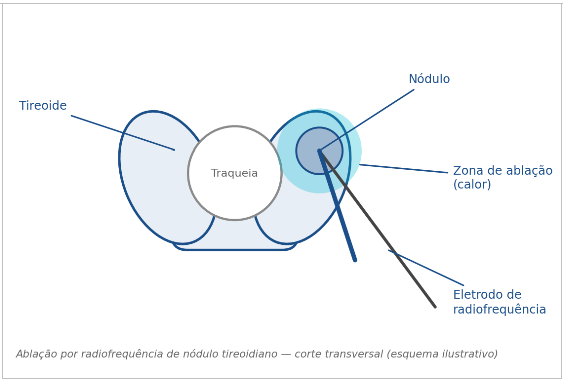Figura 1. Esquema ilustrativo da ablação por radiofrequência de um nódulo de tireoide