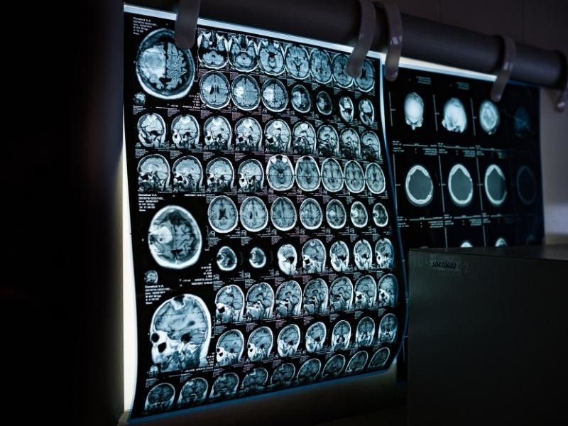 Embolização de tumor de cabeça e pescoço