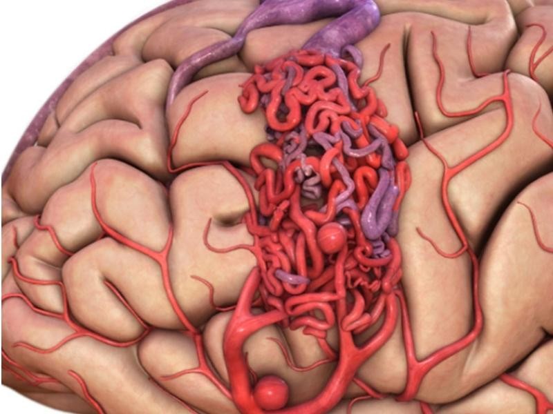 Tratamento endovascular de malformação arteriovenosa MAV cerebral