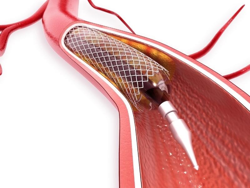 Angioplastia ilíaca
