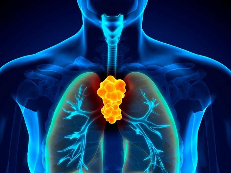 Biópsia de tumor de mediastino