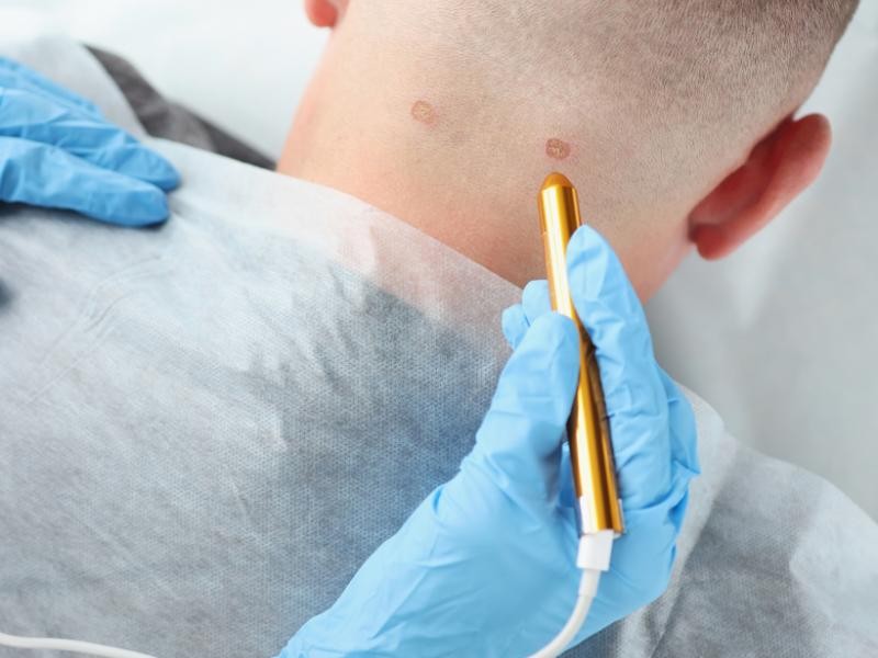 Cauterização de HPV