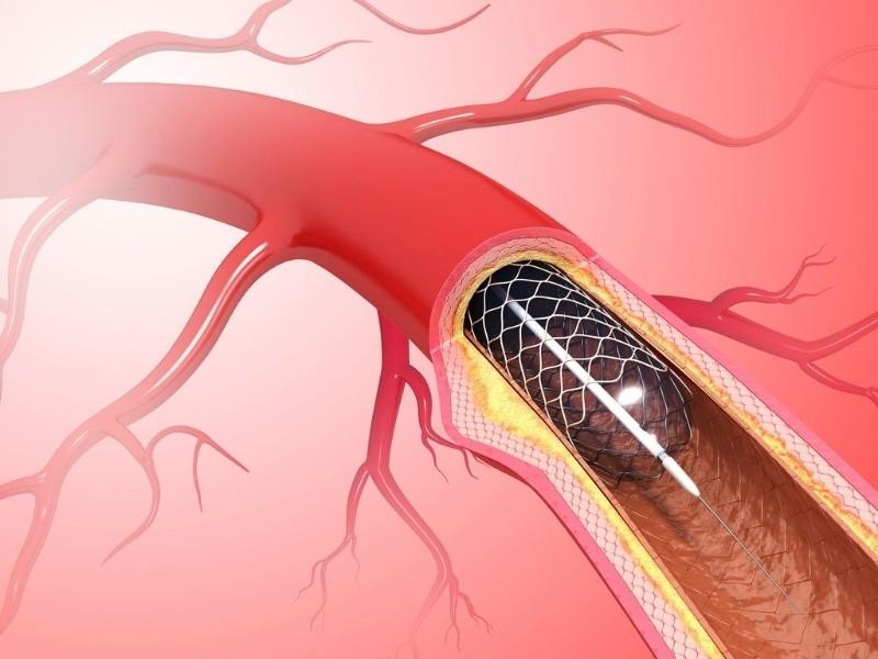 Angioplastia do vasoespasmo intracraniano