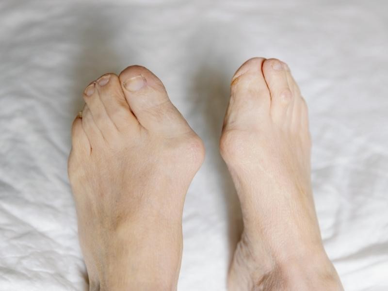 Cirurgia de halux valgo