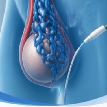 Embolização de Varicocele em Pindamonhangaba