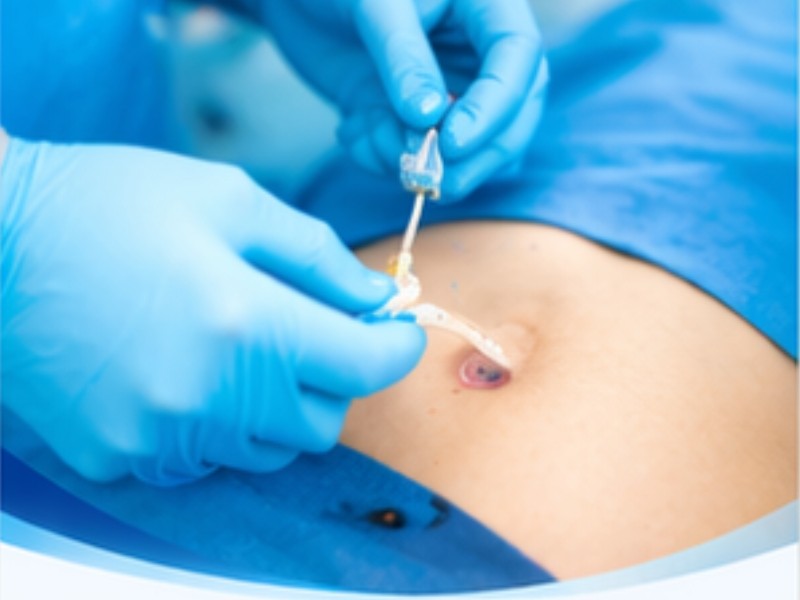 Gastrostomia